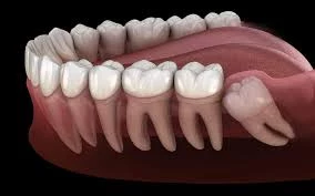 Extracción tercer molar 